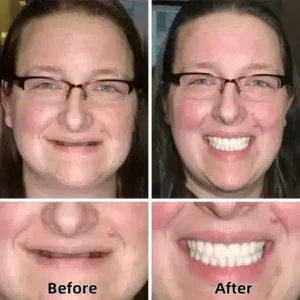 SmileFitPro™–Advanced Custom-Fit Functional Dentures